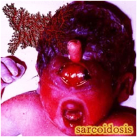 Viscera Infest - Sarcoidosis (Japanese Version)